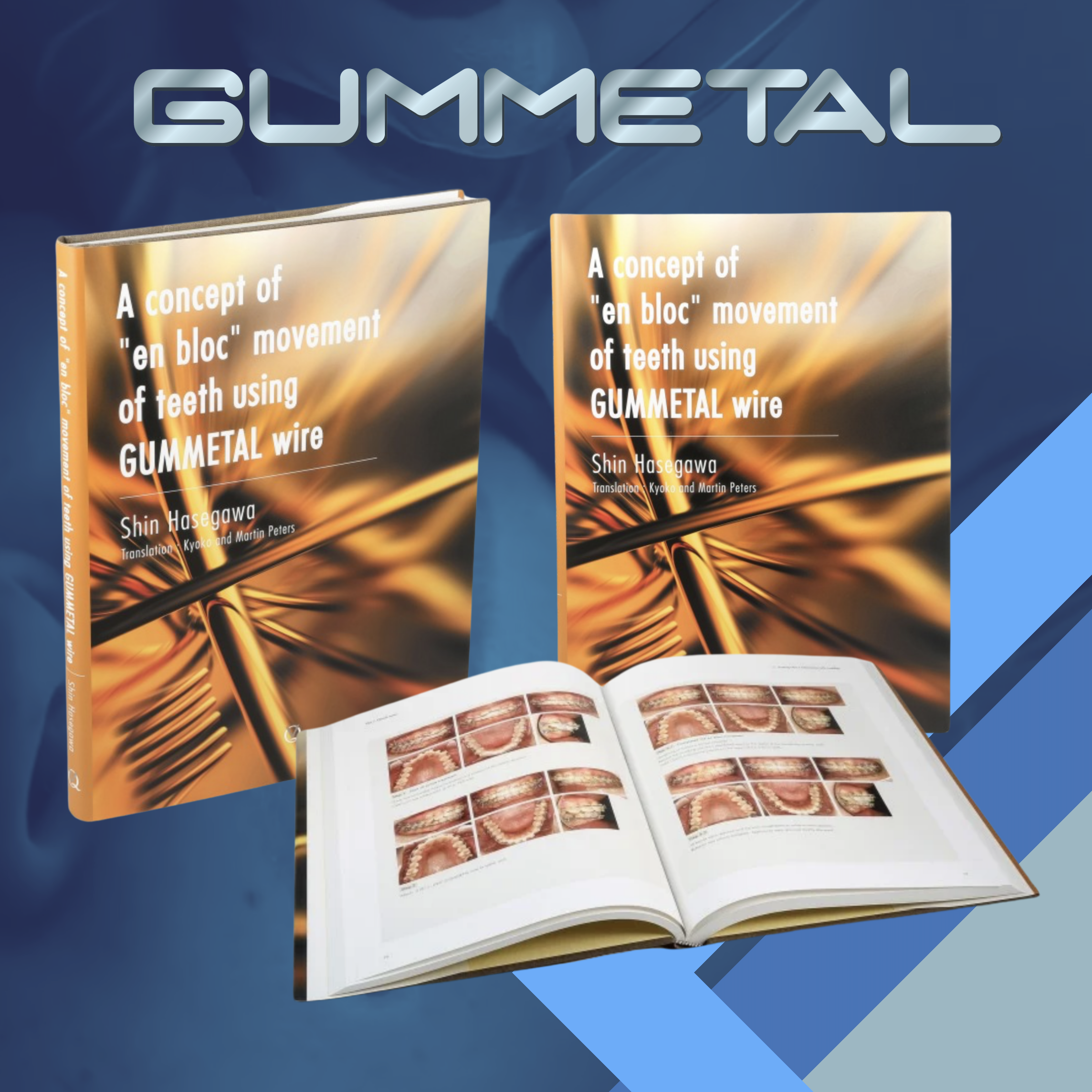 A CONCEPT OF "EN BLOC" MOVEMENT OF TEETH USING GUMMETAL WIRE